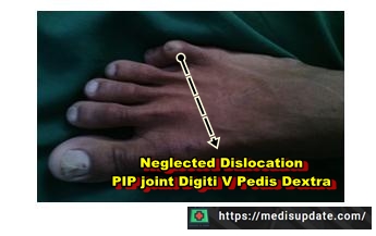 Case Report Neglected Dislocation PIP joint Pedis Dextra